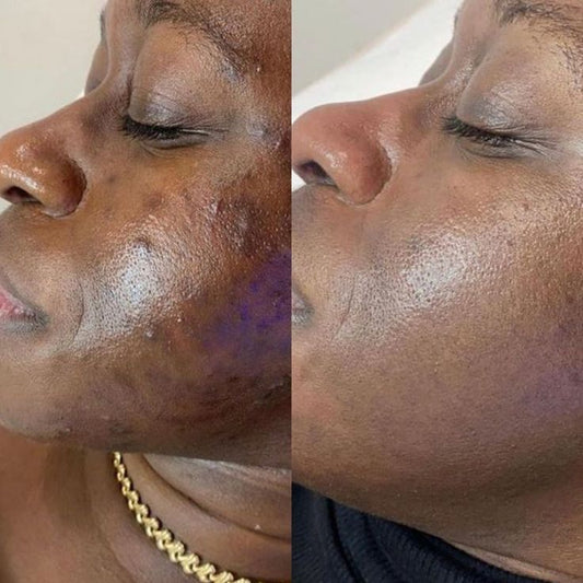 Sulpteur visage 4-en-1 : Anti-âge, Anti-acné, Anti-cernes & Anti-imperfections