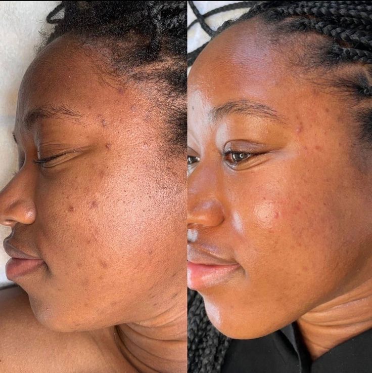 Sulpteur visage 4-en-1 : Anti-âge, Anti-acné, Anti-cernes & Anti-imperfections